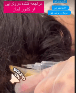 درمان ریزش مو با مزوتراپی دکتر گالیا رنجبر