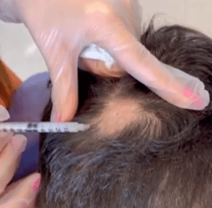 درمان ریزش مو با مزوتراپی دکتر گالیا رنجبر