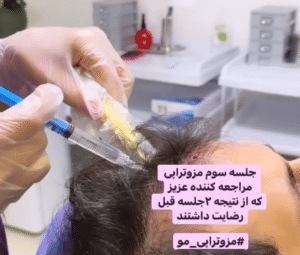 درمان ریزش مو با مزوتراپی دکتر گالیا رنجبر
