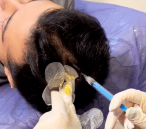 درمان ریزش مو با مزوتراپی دکتر گالیا رنجبر