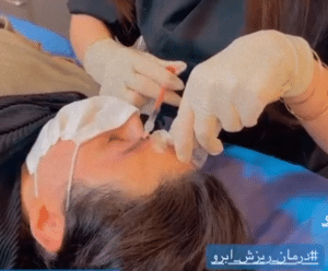 درمان ریزش مو با مزوتراپی دکتر گالیا رنجبر