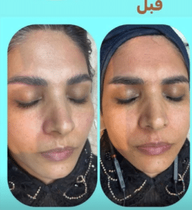 نمونه پاکسازی پوست کلینیک زیبایی کاژه