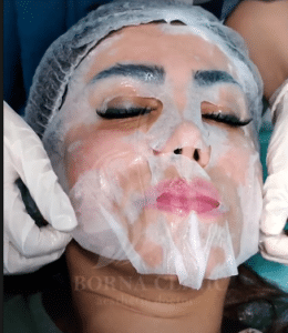 نمونه پاکسازی پوست کلینیک زیبایی برنا