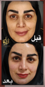 نمونه پاکسازی پوست کلینیک زیبایی برنا