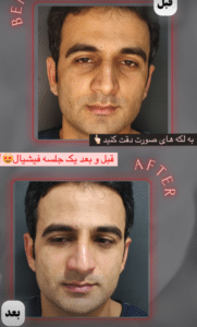 نمونه پاکسازی پوست کلینیک زیبایی برنا