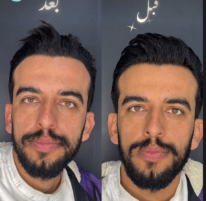 نمونه پاکسازی پوست کلینیک زیبایی برنا