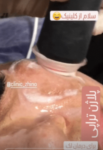 نظر کاربر اینستاگرام (کلینیک زیبایی ژینو)