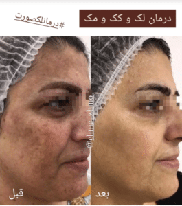 نظر کاربر اینستاگرام (کلینیک زیبایی ژینو)