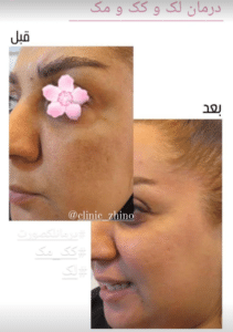 نظر کاربر اینستاگرام (کلینیک زیبایی ژینو)