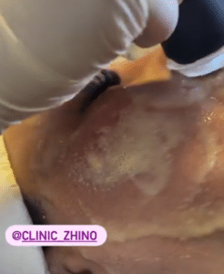 نظر کاربر اینستاگرام (کلینیک زیبایی ژینو)