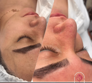 نمونه پاکسازی پوست کلینیک زیبایی الگانت