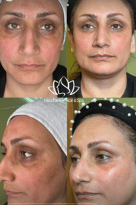 نمونه پاکسازی پوست مرکز زیبایی نیلوفر