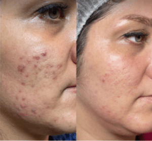 نمونه پاکسازی پوست مرکز زیبایی نیلوفر