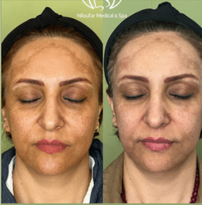 نمونه پاکسازی پوست مرکز زیبایی نیلوفر