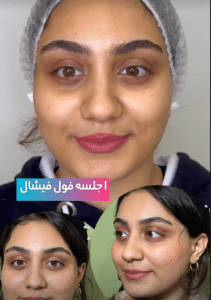 نمونه پاکسازی پوست مرکز زیبایی نیلوفر