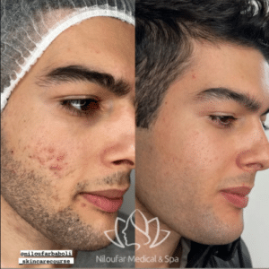 نمونه پاکسازی پوست مرکز زیبایی نیلوفر