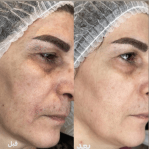 نمونه پاکسازی پوست مرکز زیبایی نیلوفر