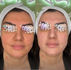 نمونه پاکسازی پوست مرکز زیبایی نیلوفر