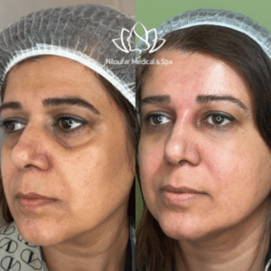 نمونه پاکسازی پوست مرکز زیبایی نیلوفر