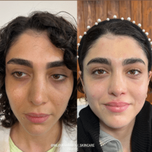 نمونه پاکسازی پوست مرکز زیبایی نیلوفر