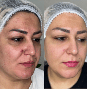 نمونه پاکسازی پوست مرکز زیبایی نیلوفر