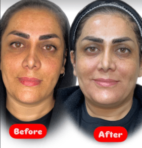 نمونه پاکسازی پوست مرکز زیبایی نیلوفر