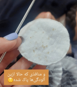 نمونه پاکسازی پوست کلینیک زیبایی رزگلد