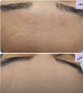 نمونه پاکسازی پوست کلینیک زیبایی رزگلد