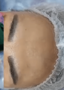 نمونه پاکسازی پوست کلینیک زیبایی رزگلد