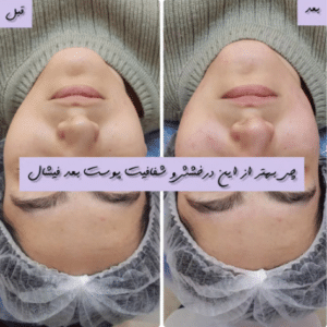 نمونه پاکسازی پوست کلینیک زیبایی رزگلد