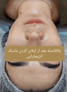 نمونه پاکسازی پوست کلینیک زیبایی رزگلد