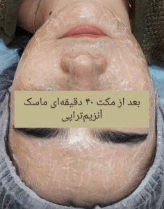 نمونه پاکسازی پوست کلینیک زیبایی رزگلد