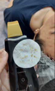 نمونه پاکسازی پوست کلینیک زیبایی رزگلد