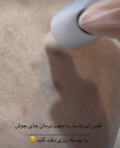 نمونه درمان جای لک و جوش دکتر زهره حاج حیدری (کلینیک زیبایی صدف)