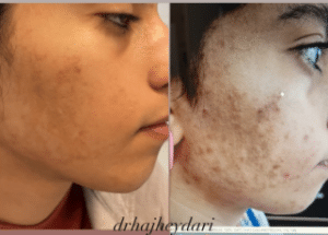 نمونه درمان جای لک و جوش دکتر زهره حاج حیدری (کلینیک زیبایی صدف)