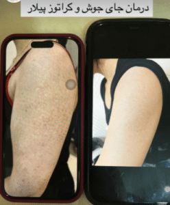 نمونه درمان جای لک و جوش دکتر زهره حاج حیدری (کلینیک زیبایی صدف)