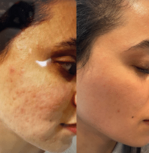 نمونه درمان جای لک و جوش دکتر زهره حاج حیدری (کلینیک زیبایی صدف)