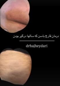 نمونه درمان جای لک و جوش دکتر زهره حاج حیدری (کلینیک زیبایی صدف)
