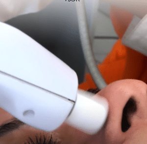 نمونه درمان جای لک و جوش دکتر زهره حاج حیدری (کلینیک زیبایی صدف)