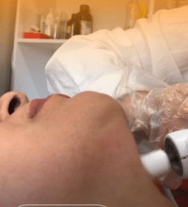 نمونه درمان جای لک و جوش دکتر زهره حاج حیدری (کلینیک زیبایی صدف)