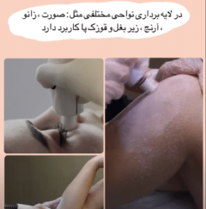 نمونه درمان جای لک و جوش دکتر زهره حاج حیدری (کلینیک زیبایی صدف)