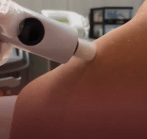 نمونه درمان جای لک و جوش دکتر زهره حاج حیدری (کلینیک زیبایی صدف)