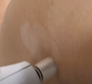 نمونه درمان جای لک و جوش دکتر زهره حاج حیدری (کلینیک زیبایی صدف)