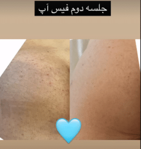 نمونه درمان جای لک و جوش دکتر زهره حاج حیدری (کلینیک زیبایی صدف)