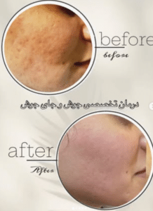 نمونه درمان جای لک و جوش دکتر زهره حاج حیدری (کلینیک زیبایی صدف)