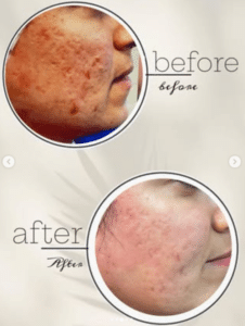 نمونه درمان جای لک و جوش دکتر زهره حاج حیدری (کلینیک زیبایی صدف)