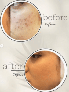 نمونه درمان جای لک و جوش دکتر زهره حاج حیدری (کلینیک زیبایی صدف)