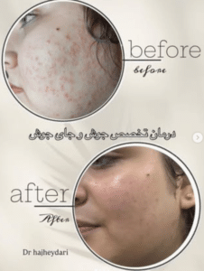 نمونه درمان جای لک و جوش دکتر زهره حاج حیدری (کلینیک زیبایی صدف)