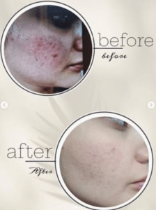 نمونه درمان جای لک و جوش دکتر زهره حاج حیدری (کلینیک زیبایی صدف)