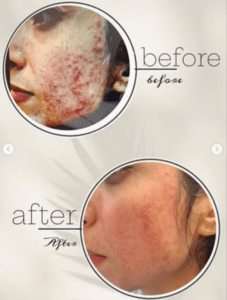 نمونه درمان جای لک و جوش دکتر زهره حاج حیدری (کلینیک زیبایی صدف)